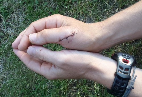 photo de la blessure